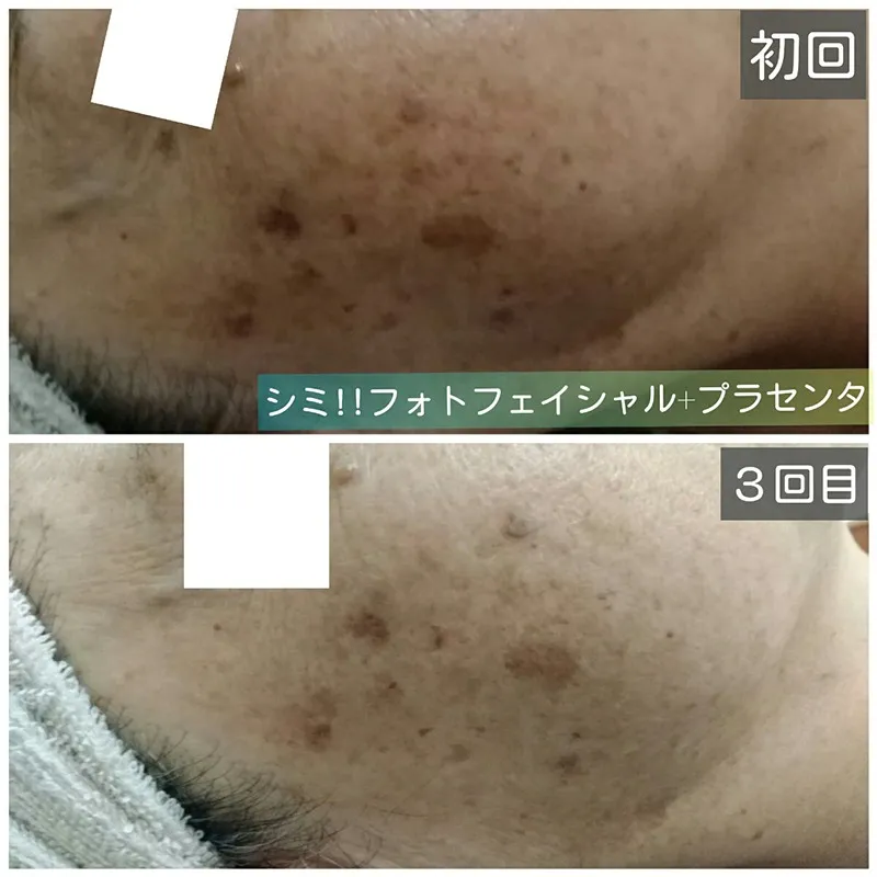 メニュー:フォトケア+プラセンタ